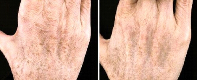 Laserowa redukcja przebarwień skóry