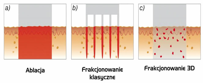 nieablacyjne zagęszczanie skóry, fotony frac3, frakcjonowanie 3d