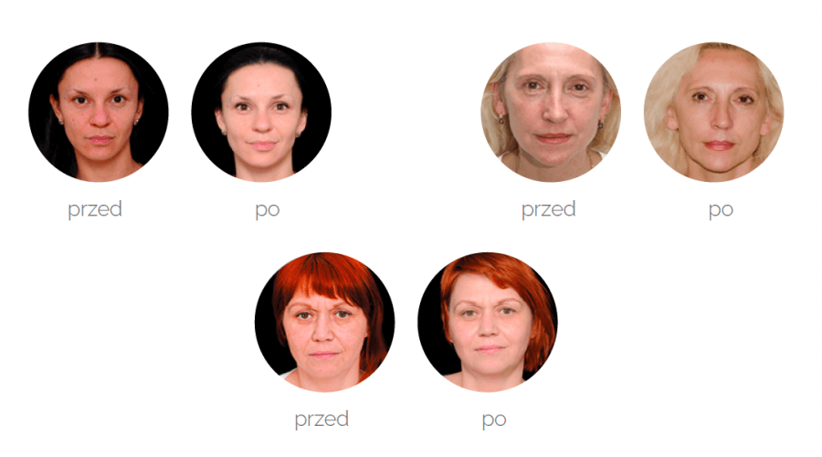 REDERMALIZACJA ANTI-AGING Zielona Góra