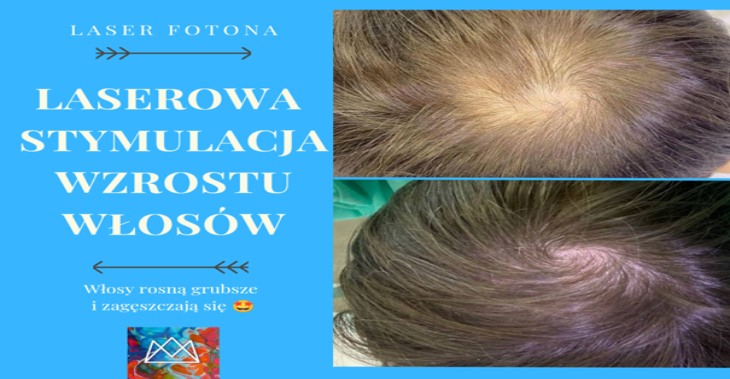 Laserowa stymulacja wzrostu włosów FOTONA w Dermasana
